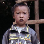 Xingyi Huang (Girl, 4, burn trauma): pictures were taken one year after the burn injury. - Li_Pannan_2